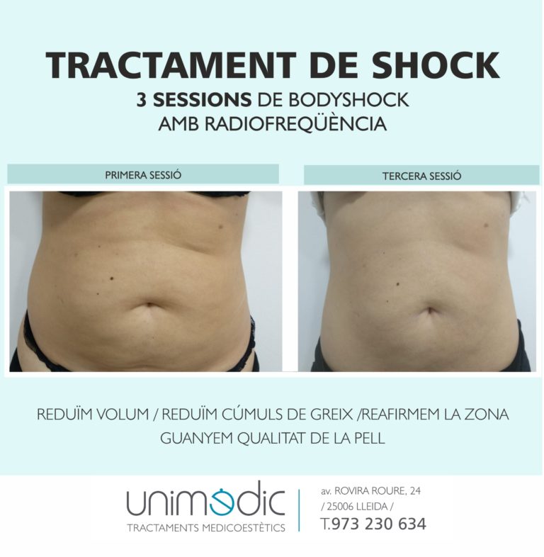 Bodyshock Mesotestic Lleida / Abans i després