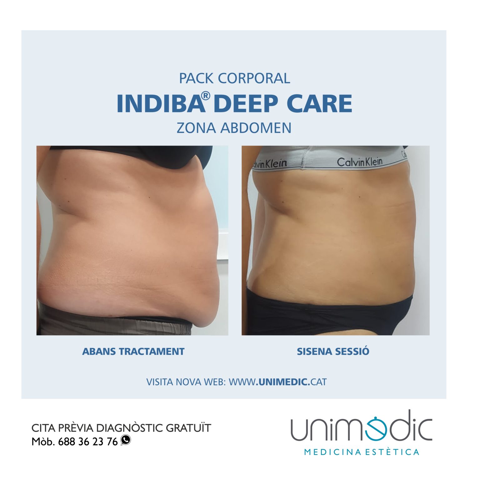 UNIMEDIC Indiba deep care_abdomen