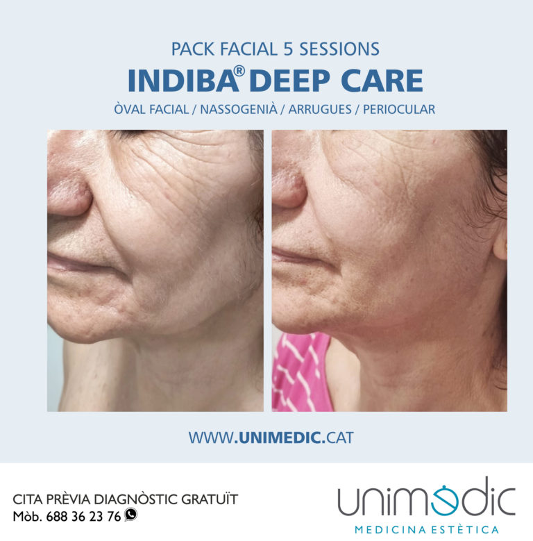 FLACIDEZ ROSTRO