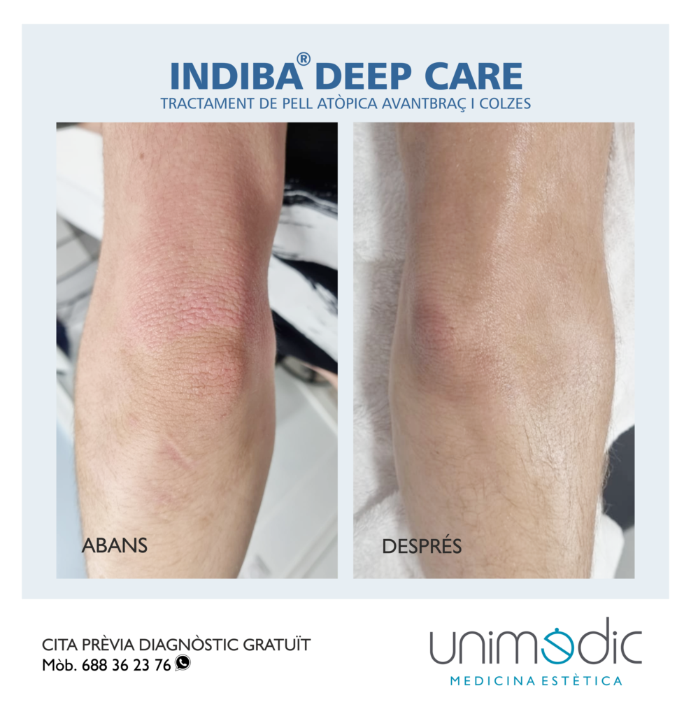 indiba deep care lleida