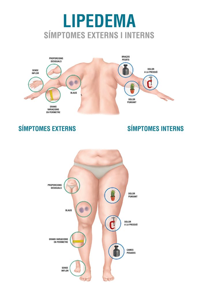 sintomas lipedema