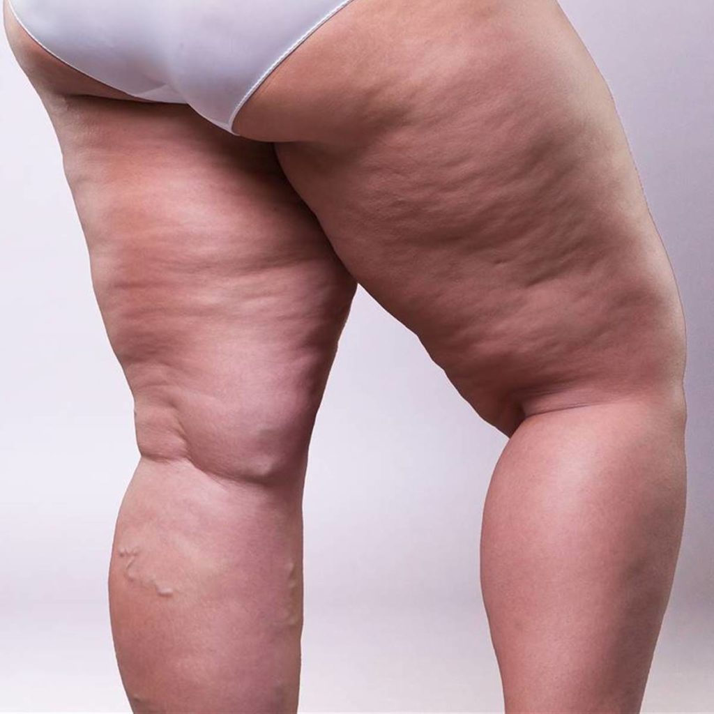 lipedema